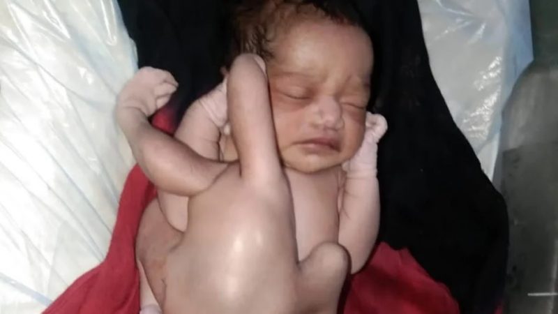 चार हाथ चार पैर वाला अनोखा बच्चा, उमड़ी भीड़, लोग बोले- भगवान का अवतार